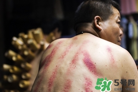 背部刮痧后能拔火罐嗎？背部刮痧后拔火罐有什么好處？
