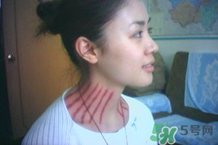 揪痧是什么？揪痧的好處有哪些？