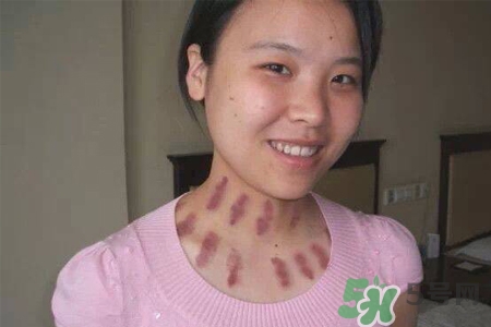 揪痧是什么？揪痧的好處有哪些？