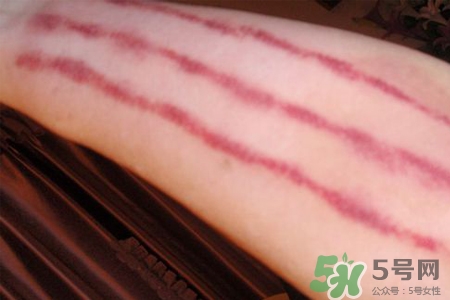 揪痧和刮痧哪個(gè)效果比較好？揪痧和刮痧的區(qū)別？