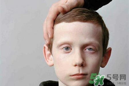 面癱能針灸嗎？針灸能治療面癱嗎？