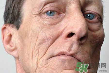 面癱能針灸嗎？針灸能治療面癱嗎？