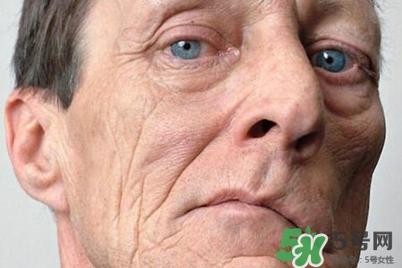 拔牙會(huì)導(dǎo)致面癱嗎?？拔牙為什么會(huì)導(dǎo)致面癱？