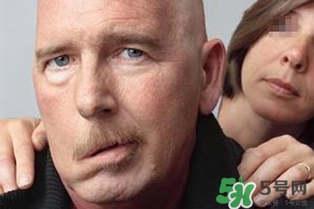 拔牙會(huì)導(dǎo)致面癱嗎?？拔牙為什么會(huì)導(dǎo)致面癱？