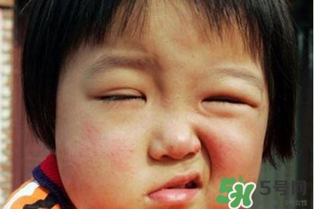 青少年面癱是怎么回事？青少年面癱是怎么辦？