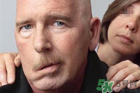 青少年面癱是怎么回事？青少年面癱是怎么辦？