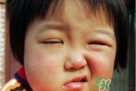 鼻炎會(huì)引起面癱嗎？鼻炎為什么會(huì)導(dǎo)致面癱？