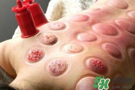 拔罐放血對身體好嗎？拔罐放血有什么好處？