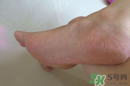 腳趾經(jīng)常抽筋是缺鈣嗎？腳趾抽筋是什么原因？