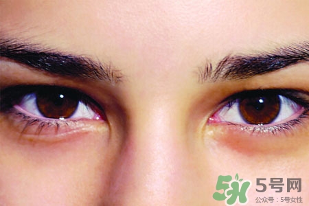 眼睛哭腫了怎么辦？眼睛哭腫了如何快速消腫？