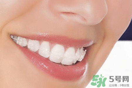 隱形牙套矯正多少錢？隱形牙套多少錢一副？