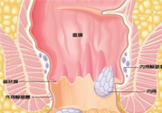 怎樣辨別外痔和內(nèi)痔？外痔和內(nèi)痔的區(qū)別