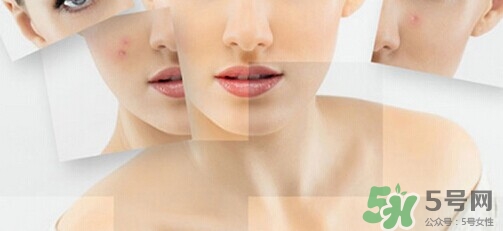 紅痣代表什么?紅痣可以點(diǎn)掉嗎? 紅痣代表什么?紅痣可以點(diǎn)掉嗎?