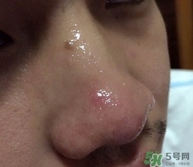 wis去黑頭套裝多少錢?wis去黑頭套裝價(jià)格 wis去黑頭套裝多少錢?wis去黑頭套裝價(jià)格