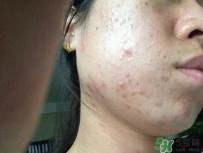 閉合性粉刺怎么消除?閉合性粉刺怎么根除?