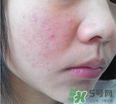 閉合性粉刺用什么藥膏?閉合性粉刺怎么治療? 閉合性粉刺用什么藥膏?閉合性粉刺怎么治療?