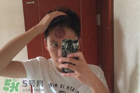 拔罐后皮膚癢能撓嗎？拔罐后身上癢切忌抓撓