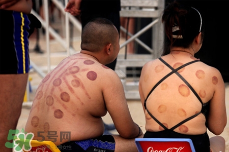 針灸火罐后多久能洗澡？針灸火罐后能馬上洗澡嗎？