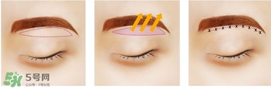 切眉后眼睛腫怎么辦？切眉后眼睛變形怎么回事怎么辦？