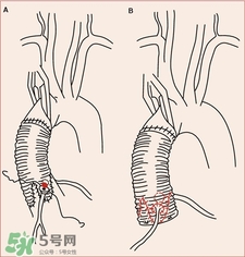 人造血管可以用多久?人造血管的護理 人造血管可以用多久?人造血管的護理