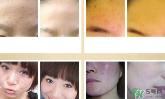 伊詩蘭頓祛痘怎么樣？伊詩蘭頓祛痘膏有用嗎？