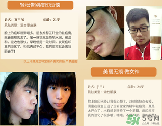 芷軒堂祛痘有效果嗎？芷軒堂祛痘印效果怎么樣？