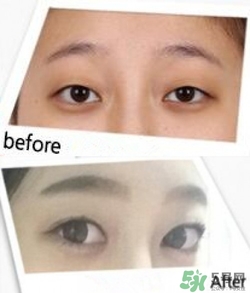 埋線雙眼皮多久恢復(fù)自然？埋線雙眼皮多久能恢復(fù)