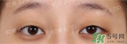 埋線雙眼皮多久恢復(fù)自然？埋線雙眼皮多久能恢復(fù)