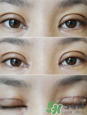 定點(diǎn)雙眼皮恢復(fù)過程圖_定點(diǎn)雙眼皮要多久恢復(fù)