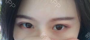 定點雙眼皮能保持多久？定點雙眼皮是永久的嗎？