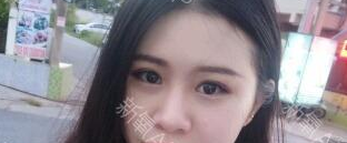 定點雙眼皮能保持多久？定點雙眼皮是永久的嗎？