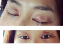 定點(diǎn)雙眼皮怎么做？定點(diǎn)雙眼皮需要拆線嗎？