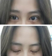 定點(diǎn)雙眼皮怎么做？定點(diǎn)雙眼皮需要拆線嗎？