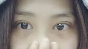 定點(diǎn)雙眼皮怎么做？定點(diǎn)雙眼皮需要拆線嗎？