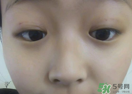 埋線(xiàn)雙眼皮需要拆線(xiàn)嗎？埋線(xiàn)雙眼皮怎么拆線(xiàn)