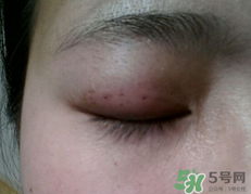 埋線(xiàn)雙眼皮需要拆線(xiàn)嗎？埋線(xiàn)雙眼皮怎么拆線(xiàn)