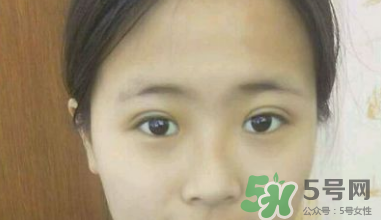 埋線(xiàn)雙眼皮需要拆線(xiàn)嗎？埋線(xiàn)雙眼皮怎么拆線(xiàn)