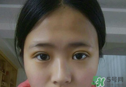 埋線(xiàn)雙眼皮需要拆線(xiàn)嗎？埋線(xiàn)雙眼皮怎么拆線(xiàn)