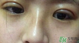 埋線(xiàn)雙眼皮需要拆線(xiàn)嗎？埋線(xiàn)雙眼皮怎么拆線(xiàn)