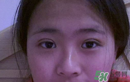 埋線(xiàn)雙眼皮需要拆線(xiàn)嗎？埋線(xiàn)雙眼皮怎么拆線(xiàn)