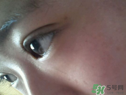 埋線(xiàn)雙眼皮需要拆線(xiàn)嗎？埋線(xiàn)雙眼皮怎么拆線(xiàn)