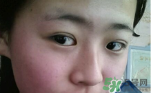 埋線(xiàn)雙眼皮需要拆線(xiàn)嗎？埋線(xiàn)雙眼皮怎么拆線(xiàn)