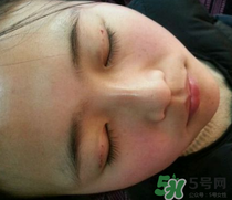 埋線(xiàn)雙眼皮需要拆線(xiàn)嗎？埋線(xiàn)雙眼皮怎么拆線(xiàn)