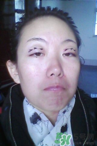 什么是定點雙眼皮？定點雙眼皮多少錢？