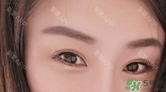 埋線雙眼皮能保持多久？埋線雙眼皮是永久嗎