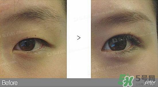 埋線(xiàn)雙眼皮需要拆線(xiàn)嗎？埋線(xiàn)雙眼皮怎么拆線(xiàn)