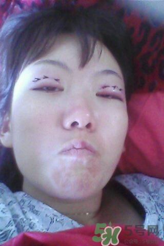 什么是定點雙眼皮？定點雙眼皮多少錢？