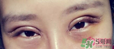 切開雙眼皮多久消腫？切開雙眼皮多久恢復？