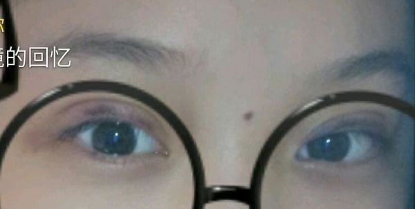 定點(diǎn)雙眼皮恢復(fù)過程圖_定點(diǎn)雙眼皮要多久恢復(fù)