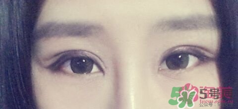 切開雙眼皮多久消腫？切開雙眼皮多久恢復？